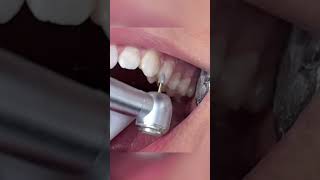 Removing Invisalign Attachments  How Are Attachments Removed  TheBracesDoc [upl. by Zysk]