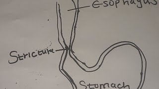 COMPLICATIONS OF ACID REFLUXGERD [upl. by Filide]