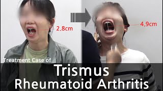 Trismus  Rheumatoid Arthritis  개구장애  류마티스 관절염 치료사례 [upl. by Arther625]