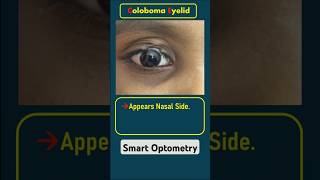 Eyelid Coloboma optometry optometrist optometrists optometrista eyedisease eyediseases eyelid [upl. by Phillis]