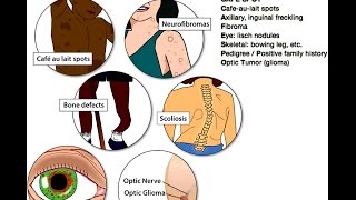 Neurofibromatosis Type 1 NF1 Mnemonic for Licensing Exams [upl. by Ynelram]