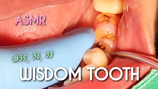 ASMR Severely Broken Tooth Extraction [upl. by Repsag50]