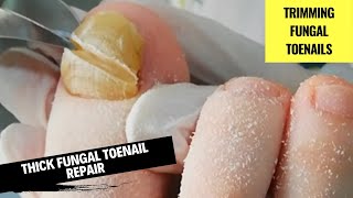 Thick Fungal Toenail Repair 🦶 Ingrown Fungal Nail Treatment 🦶 Podiatry Foot Exam [upl. by Yelsek]