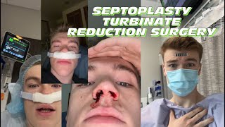 Septoplasty Turbinate Reduction Surgery Recovery vlog  tips ￼ [upl. by Kalinda]