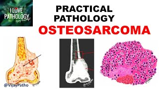 OSTEOSARCOMA Clinical  Radiological features amp Morphology [upl. by Letsyrhc38]