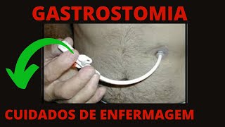 Gastrostomia e a Enfermagem  Cuidados de enfermagem com gastrostomia [upl. by Erialcyram503]