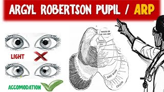 Exploring Argyl Robertson Pupil and ARP Syphilitic Pupil  Light near dissociation [upl. by Thora]