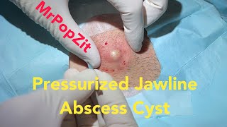 Pressurized Jawline Abscess Cyst Squirting cyst pop with surprising large sac dissection on neck [upl. by Gitlow]