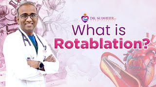 What is Rotablation Dr Sudheer Koganti [upl. by Linet719]