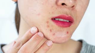 Uncover the Truth Behind Skin Spots Petechiae [upl. by Tehcac]