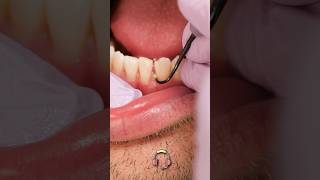 ASMR teeth scaling at the dentist shorts [upl. by Anastas650]