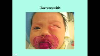 Dacryocystitis  CRASH Medical Review Series [upl. by Airdnala]