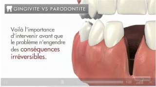 Gingivite vs parodontite [upl. by Georgianne]