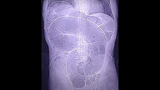 Sigmoid volvulus  typical case CT findings [upl. by Sula556]