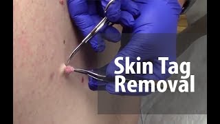 Skin Tag Removal  Dr Derm [upl. by Enamrahs]