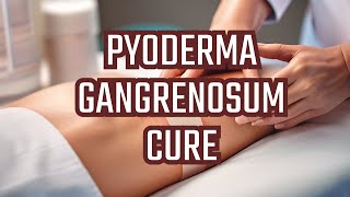 Treatment of Pyoderma gangrenosum [upl. by Ahselef]