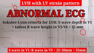 ECG Learn about STRAIN PATTERN  Very important topic [upl. by Olympe]