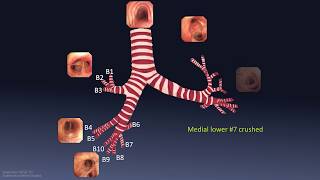 Mastering Bronchoscopy for Thoracic Surgery Chapter 1 [upl. by Ylerebmik]