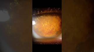 Synchysis scintillans or cholesterolosis bulbi shorts viral education optometrists ytshorts [upl. by Anivad]