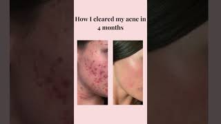 How I cleared my acne in 4 months shorts skincare acne [upl. by Keyte]