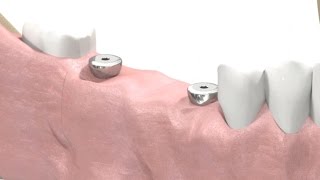 SIC invent Dental Implant  Prosthetic Animation BridgeWork Open Tray Technique [upl. by Capwell683]