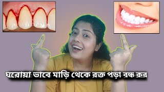 মাড়ি থেকে রক্ত বন্ধ করার ঘরোয়া টিপস।।😃😃🦷 Gum bleeding causes and its treatment at home ।। 😃😃 [upl. by Florentia916]