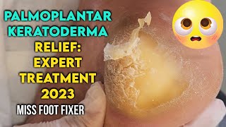 Palmoplantar Keratoderma Relief Expert Treatment for Thick Callus Removal by miss foot fixer [upl. by Lewse]