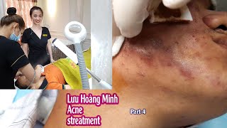 Acne treatment reputation effective at Hien Van Spa383I Lưu hoàng Minhpart4 [upl. by Anoved77]