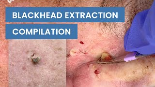 Extraction Satisfaction Blackhead Removal  CONTOUR DERMATOLOGY [upl. by Omura]