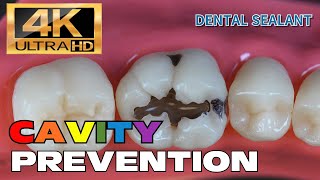 HOW TO PREVENT CAVITIES DENTAL SEALANT [upl. by Martreb]