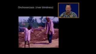 onchocerciasis river blindness [upl. by Hoem232]