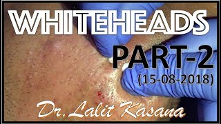 ANTI ACNE TREATMENT PART2 BY DRLALIT KASANA15082018 [upl. by Tootsie963]