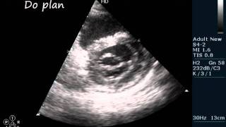 MSMR RHD ECHOCARDIOGRAPHY SERIES BY DRANKURKCHAUDHARI [upl. by Vonni]