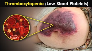 Thrombocytopenia Causes Symptoms and Treatment 3d Animation  low blood platelets [upl. by Audris771]