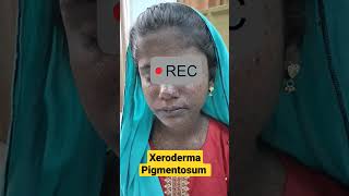 Xeroderma Pigmentosum  DermaCase  Basal cell amp Squamous cell Carcinoma  Sun induced Pigmentation [upl. by Karlie]