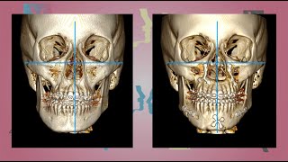 Case 14  Orthognathic surgery  Facial Asymmetry  English [upl. by Mccullough874]