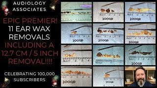 1 HR11 EAR WAX REMOVALS [upl. by Jasmina]