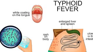 typhoid fever health talk [upl. by Hawker]