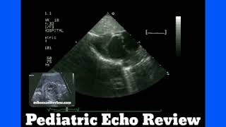 Complete AV Canal Dextrocardia Levotransposition of the Great Arteries LTGA [upl. by Egiaf]