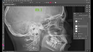 Cephalometrics Part 1 المرحلة الخامسة [upl. by Aretak]