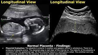 Placenta Ultrasound Reporting  How To Write Pregnancy USG Reports  Pathologies amp Positions Scans [upl. by Esilrac]