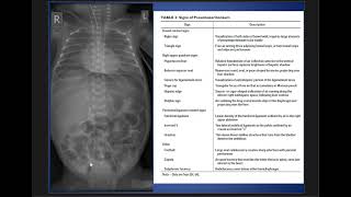 Case Discussion  Pneumoperitoneum [upl. by Juanne]