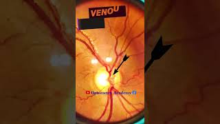 Venous Pulsation  Normal fundus  Normal Retina  Fundus Photography  Short Video 101 optometry [upl. by Leumel52]