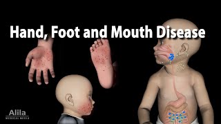 Hand Foot Mouth Disease [upl. by Scutt]