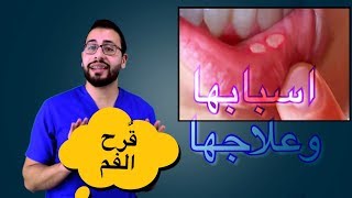 ❓كيف تتخلصون من تقرحات الفم ؟ و طرق تجنب الاصابة بها ؟؟ [upl. by Lledner]