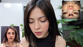 BIGGEST REGRET IN MY LIFE Rhinoplasty Journey Pt2  Mika Salamanca [upl. by Nolak]