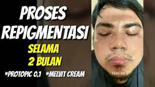 Proses Repigmentasi Sampai Vitiligo Hilang Menggunakan Protopic dan Melvit Cream Selama 2 bulan [upl. by Htennaj380]