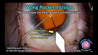 CataractCoach™ 2362 Wong pocket to seal corneal phaco incisions [upl. by Cherlyn]