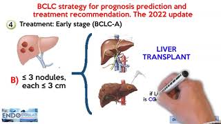 Barcelona Clinic Liver Cancer BCLC staging system The 2022 update [upl. by Meraree370]