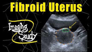 Fibroid Uterus  Ultrasound  Case 120 [upl. by Meehyr]